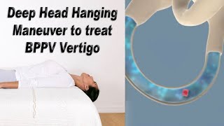 Deep Head Hanging Maneuver to Treat BPPV Vertigo [upl. by Ardene]