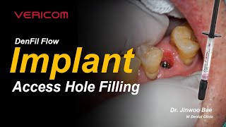 DenFil Flow Implant Access Hole Filling [upl. by Aikemit87]