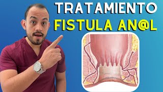 🔴 𝗙𝗜𝗦𝗧𝗨𝗟𝗔 𝗔𝗡𝗔𝗟 Síntomas Causas y Tratamiento [upl. by Tnirb339]