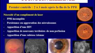 traitement au laser de la retinopathie Diabetique [upl. by Felisha]