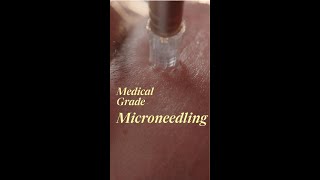 Medical Grade Microneedling [upl. by Milicent422]