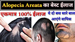 Alopecia Areata का बेस्ट ईलाज  Allopathic treatment of Alopecia Areata  Hair fall [upl. by Rida]