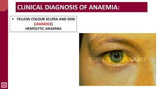 Hematology  1  U5L7  Clinical diagnosis of anaemia [upl. by Dessma]