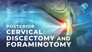 What is Endoscopic Posterior Cervical Discectomy and Foraminotomy [upl. by Nostrebor506]