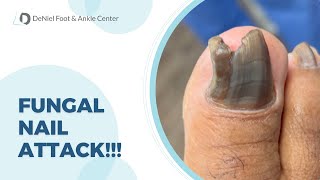 FUNGAL NAIL ATTACK toenailfungus toenailfungustreatment footdoctor [upl. by Herculie834]