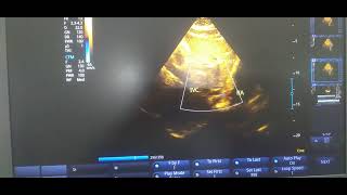 Subcostal view showing IVC with normal dimension and inspiratory collapse [upl. by Thgirw]