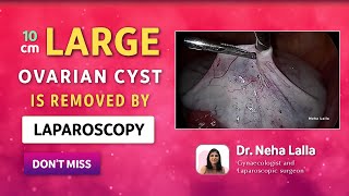 2022 Ovarian Cyst Signs and Symptoms  Scarless Laparoscopic Treatment  Dr Neha Lalla [upl. by Raynard689]