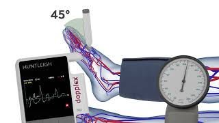 How to Measure the Systolic Pressure of the Dorsalis Pedis when Performing an ABPI [upl. by Nalim961]