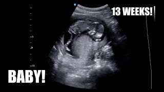 Beautiful Ultrasound Video of 12 Weeks Pregnancy [upl. by Tarah313]