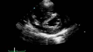 A 17YearOld Girl with Chest Pain and Hemoptysis [upl. by Lew]