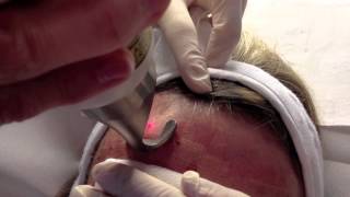 Resurfacing dermabrasion du visage au laser Erbium [upl. by Choong]