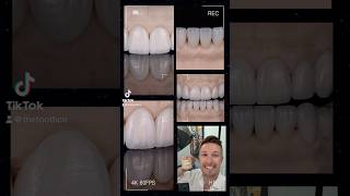 Veneers at The Tooth Co ocveneers irvinedentist cosmeticdentistry veneers porcelainveneers [upl. by Enyale610]