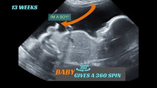 13 weeks  Baby boy  does 360 spin in womb  Ultrasound [upl. by Nats]