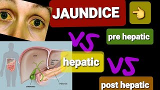 JAUNDICE  PRE HEPATIC VS POST HEPATIC JAUNDICE  DR SHAHRUKH [upl. by Berlin]