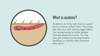 Scabies Signs Symptoms Causes and Treatment  Merck Manual Consumer Version [upl. by Rebecca908]