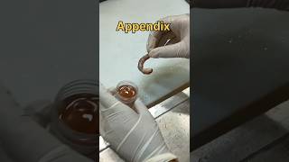 Appendicitis specimen [upl. by Marek719]