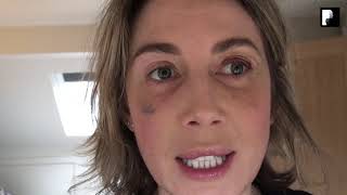 Blepharoplasty Video Diary  Day 10 After Surgery 8 of 15 [upl. by Anilorac]