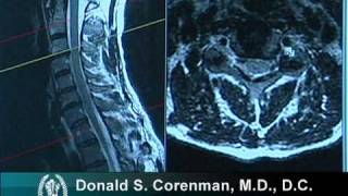 How to Read a MRI of Cervical Nerve Compression  Neck Pain  Colorado Spine Surgeon [upl. by Debi44]