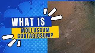 What is molluscum contagiosum [upl. by Ahsieyk]