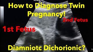 Twin Pregnancy  Diamniotic Dichorionic how to diagnose  easy steps [upl. by Ragnar]