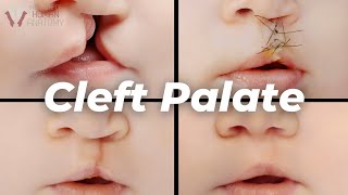 Why Cleft Palates Occur A Scientific Explanation [upl. by Atalie]