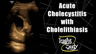 Acute Cholecystitis with Cholelithiasis  Ultrasound  Case 80 [upl. by Aileon]