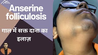 Anserine folliculosis  rough skin on chin  cheek  गाल में सक्त दाना का इलाज़  Dr Uttam Lenka [upl. by Nivrem]