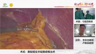 Laparoscopic left hemicolectomy 左半结肠癌根治术 [upl. by Eilyac]