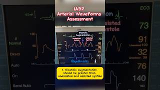 IABP Arterial Waveform Assessment cardiology criticalcare cathlab [upl. by Addam399]