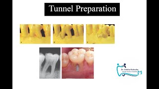 TUNNEL PREPARATIONTREATMENT OF FURCATION INVOLVEMENTDR ANKITA KOTECHADENTAL STUDIES SIMPLIFIED [upl. by Carmel]