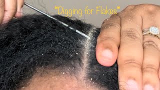 ASMR Scalp Scratching to Help you Relax • Nitpicking Dandruff Scalp Check • Psoriasis Flakes [upl. by Coney]