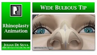 Rhinoplasty animation  How can a Large and Wide Bulbous Tip be made smaller [upl. by Phylys]