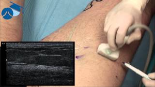 Marking hidden varicose veins for ultrasound guided phlebectomies [upl. by Ennirac]