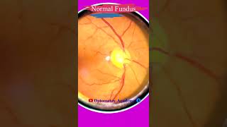 Normal fundus  Normal Retina  Smartphone Fundus Videography  Fundus Photography  Short Video 87 [upl. by Tiedeman]