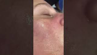 Clogged Pores amp how we unclog them  Dr Medispa [upl. by Ilrebmyk]