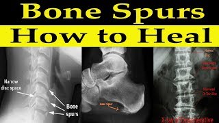 How to Heal Bone Spurs Naturally  Dr Alan Mandell DC [upl. by Norret]