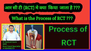 आर सी टी RCT मे क्या किया जाता है  What is the Process of RCT [upl. by Davita]