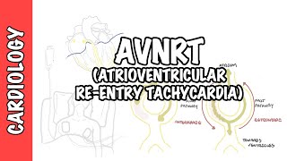 AVRNT atrioventricular reentry tachycardia  causes pathophysiology treatment [upl. by Enair]