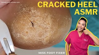 Exploring the Mythology of the Cracked Heel ASMR  Miss Foot Fixer [upl. by Farah]