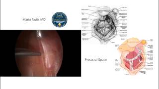 Laparoscopic Presacral Neurectomy [upl. by Arrais300]