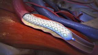 Peripheral Vascular Disease balloon stent by Gore Medical [upl. by Betthezul67]