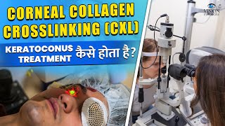 Corneal Collagen Crosslinking CXL Treatment कैसे होता है  Keratoconus Treatment Procedure [upl. by Raimondo358]