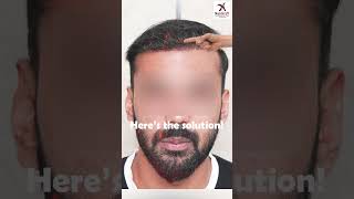 Struggling With Baldness  We Have a SOLUTION  hairtransformation besthairtransplantclinic [upl. by Lrem]