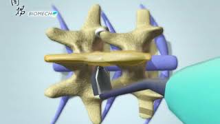 Biomech PAONAN Rocker Interspinous Process System [upl. by Naiditch]