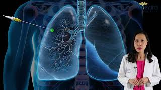 Diagnosing Lung Cancer by early identification of pulmonary nodules [upl. by Winou]