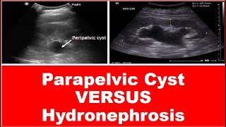 Parapelvic cyst versus hydronephrosis [upl. by Inanuah658]