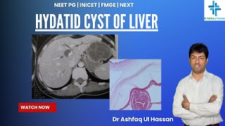 Hydatid Cyst of Liver  An important Question asked in FMGE 2024  Expected in NEET PG [upl. by Orazio]