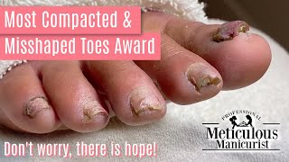 How to Pedicure Transformation the Most Compacted amp Misshapen Toenails [upl. by Zined]