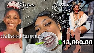 MY TEETH JOURNEY VLOG  VENEERS PROCESS EXPERIENCE IN MIAMI [upl. by Enitnelav]