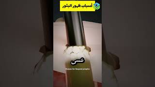 أسباب ظهور الحبوب على الجلد بشكل متكرر 😳🔥 edumedical [upl. by Eillas]